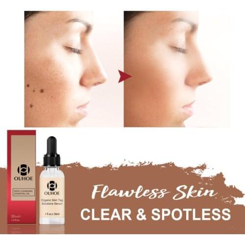 30ml Organic Mole removal Serum repair Skin Tag Remover Skin Spot Purifying Serum Tags Warts Remover Smooth Facial Care TSLM1