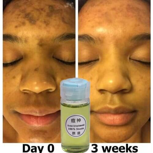 10ML Herbals Acne N Pimple Face Oil Cream Spots BlackHead Blemish Treatment Korean Skin Care