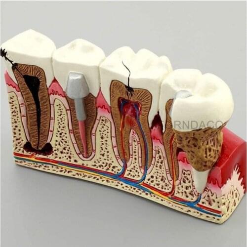Demonstration Dental Anatomy Caries Oral Model Medical Teaching Study Communication
