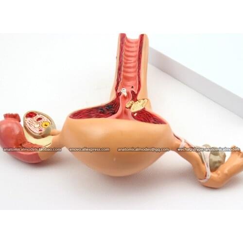 CMAM/12441 Pathological Uterine Vagina, Genitourinary Medical Teaching Anatomical Model