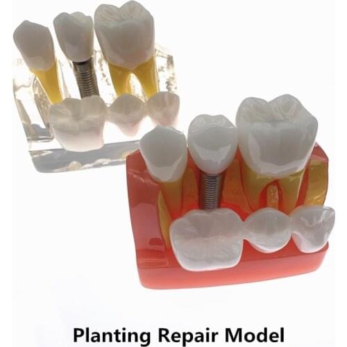 Dental 4 times planting Teeth model Analysis Crown Bridge Removable Model Dental Teaching Research Model