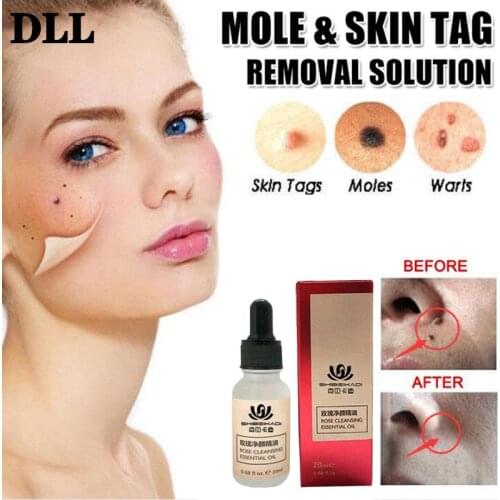 1 Box20ml Freckle Removal Cream Oil Mole & Skin Tag Removal Painless Mole Skin Dark Spot Removal Face Wart Tag