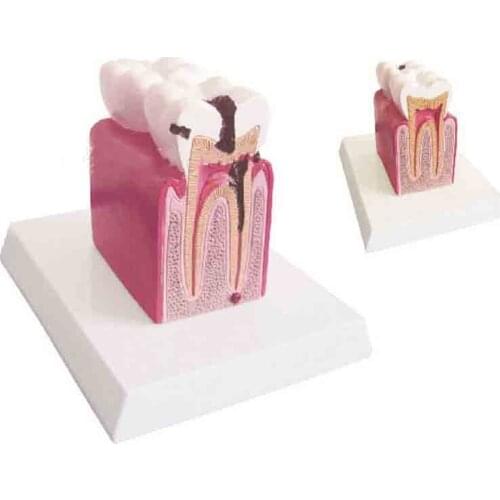SMT0225 Dental Pathology Model