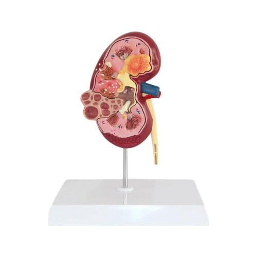 Human Kidney pathology Dissection Model Kidney disease free shipping