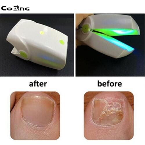 Foot Fungus Anti Fungal Care Treatment Onychomycosis Laser Therapy Device