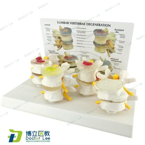 4 Stages Normal and Disease Lumbar Vertebra Model Vertebrae Human Anatomy Skeleton for Medical Science Teaching