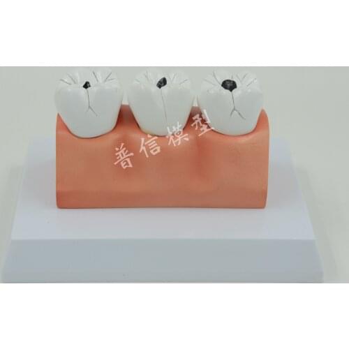 Dental caries model,Dental dental model ,dental cast model for department of dentistry display, ,Medical anatomy model