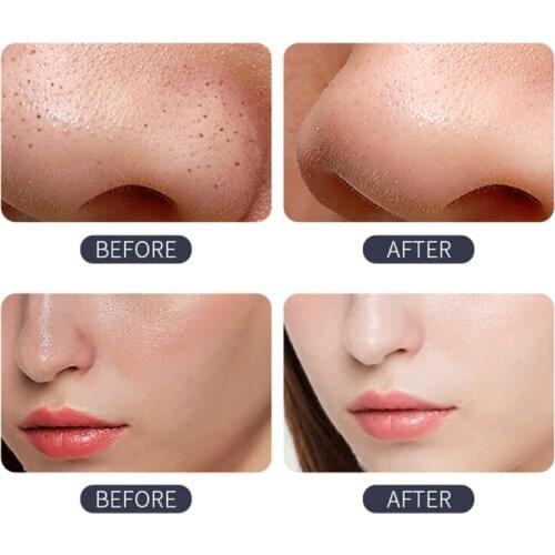 Portable Electric Pore Vacuum Cleaner Blackhead Remover Acne Comedone Extractor U2JD