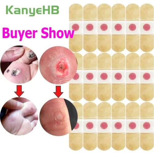 18pcs Medical Plaster Foot Corn Removal Warts Thorn patches Corn of foot Calluses Callosity Detox clavus Medical Plaster A292
