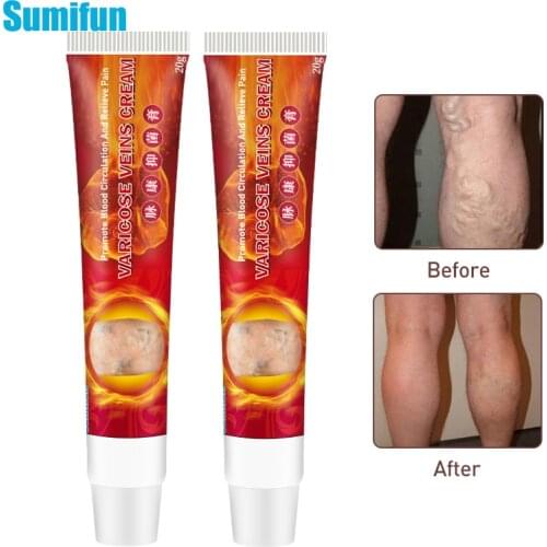 SMF 20g Varicose Veins Ointment Herbal Medical Plaster Varicosity Angiitis Removal Oil Vasculitis Phlebitis Spider Cream 1Pcs
