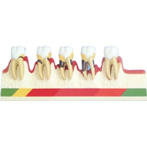 Demonstrate the processes of different periodontic diseases Developing Model simple gingivitis to light,medium,hard chronic