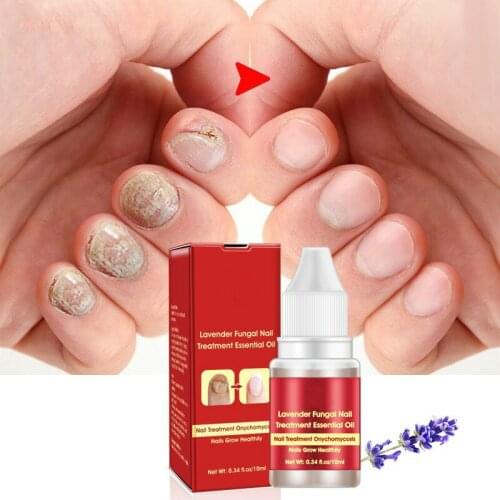 Fungal Nail Treatment Serum Onychomycosis Paronychia Anti-Fungal Nail Infection Herbal Toe Fungus Foot Repair Essence Care 10ml
