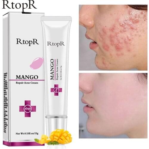 Useful Mango Acne Treatment Face Cream Blackhead Repair Gel Oil Control Shrink Pore Scar Whitening Moisturize Skin Care Cosmetic