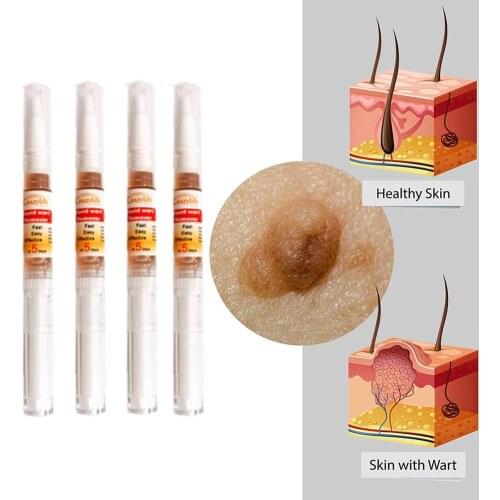 4pcs Genital Wart Treatment Papillomas Removal Of Warts Liquid From Skin Tags Removing Against Moles Remover Anti Verruca Remedy