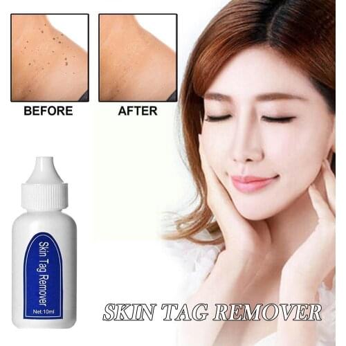 Wart Removal Beauty Liquid Genital Wart Treatment Papillomas Liquid Warts Removal Removing Tags Skin From of Z6K8