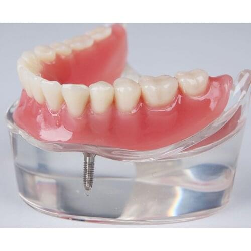 M6002 Overdenture Restoration Model with 2 Implant Mandibular Overdenture Dental Tooth Model M6002A