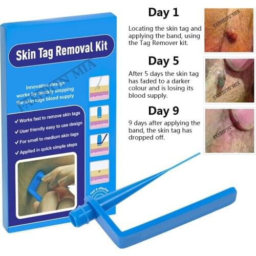 Home use skin tag remover band micro skin tag removal device kit acne remover Cone Set for Mole Wart Removal Treatment skin care