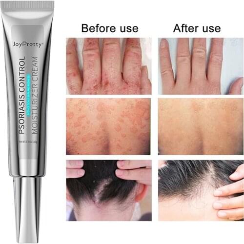 20g Psoriasis Cream Natural Anti-Itching Ointment Fungal Treatment for Dermatitis Eczema Dry Cracked Moisturize Cream Skin care