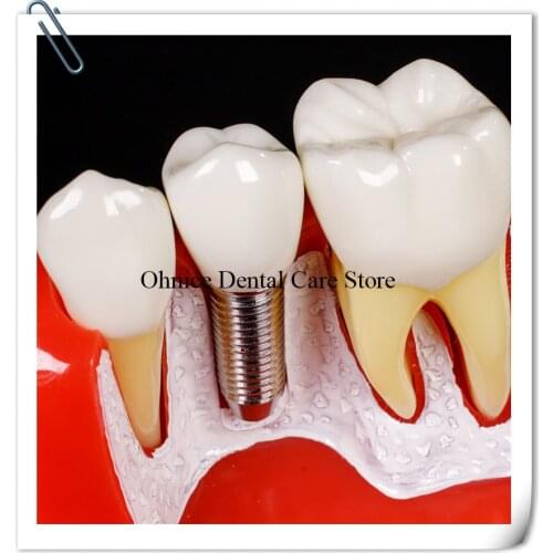 Dental Impalnt Analysis teeth model M2017/Dental Implant teaching model Explain fretures and bridge/Dental Comminication model