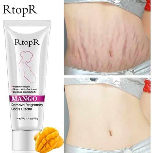 Mango Remove Pregnancy Scars Acne Cream Stretch Marks Treatment Maternity Repair Anti-Aging Anti-Winkles Firming Body Creams