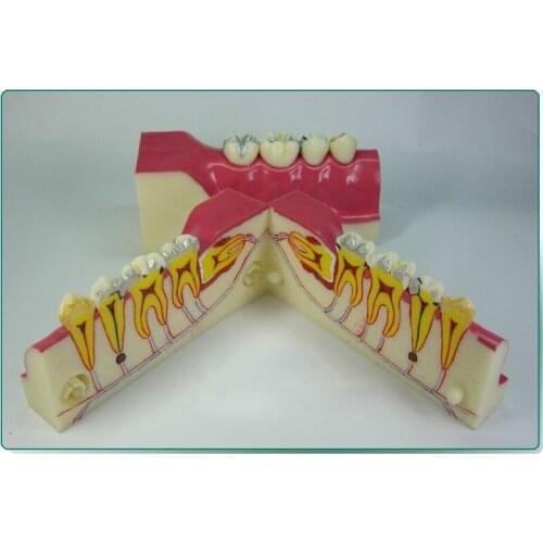 2X Life Size Free Shipping Model with Inside Bracket Dental Tooth Teeth Dentist Dentistry Anatomical Anatomy Model odontologia