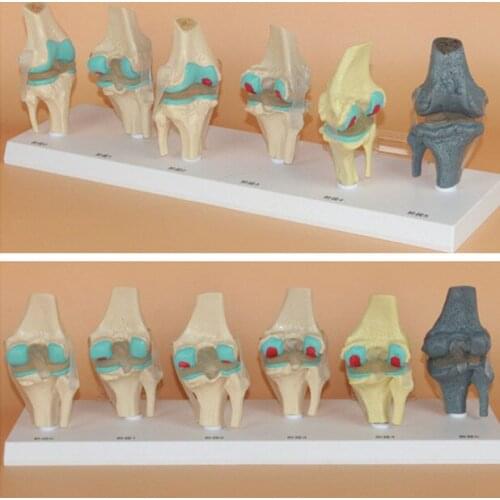 6 pcs Knee joint disease process demonstration model Orthopedic teaching Knee joint lesion model