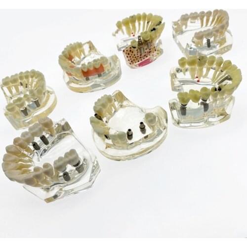 Dental Teeth model dental Implant model With Bridge and Caries Dentist Teaching Research Model