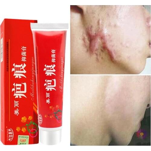 60g Acne Scar Removal Cream Pimples Stretch Marks Face Gel Remove Acne Smoothing Whitening Moisturizing Body Skin Care