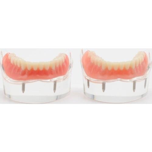 Lower Mandibular With 2/4 Implants Restoration Teach Model For Dental Study