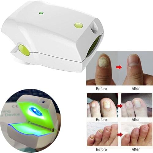 Light Therapy Device Anti Toenail Fungal Onychomycosis Stop Nail Fungal Infection Nail Fungus Cleaner