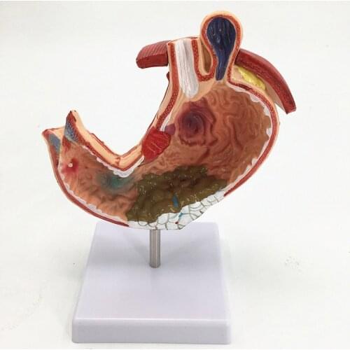 Human Anatomical Anatomy Stomach Medical Model Gastric Pathology Gastritis Ulcer Medical Teaching Learning Tool
