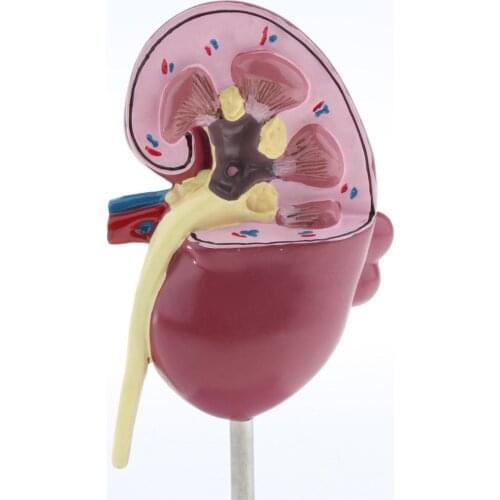 Kidney Human Anatomical Model 2Sided, Normal and with Pathologies