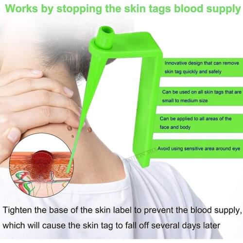 Household Skin Tag Remover Mole Wart Remover Micro Skin Tag Removal Kit With Clean Swabs Kill Mole Wart Face Beauty Care Tool