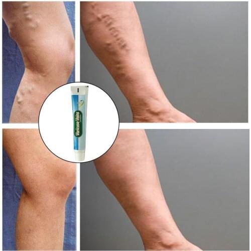 Varicose Veins Ointment Vasculitis Treatment Phlebitis Legs Blood Inflammation Treatment Cream Vessel Rotten Angiitis Spide F0S3