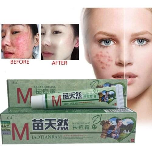 18g Acne Removal Cream Sterilization and Mite Removal Moisturizing Skin Cream Care Moisturizing Moisturizing Cream