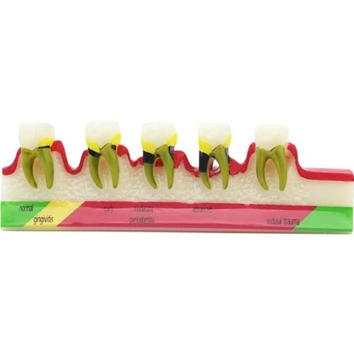 Dental Teeth Model for Periodontal pathological Diseases Assorting & Pathology Tooth Classification