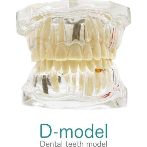 Teeth Model Dental Implant Teaching Study With Restoration Bridge Tooth Dentist Medical Science Dental Disease Teaching Study