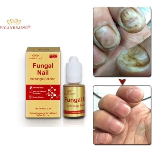 Масла от грибка ногтей YIGANERJING China At AliExpress