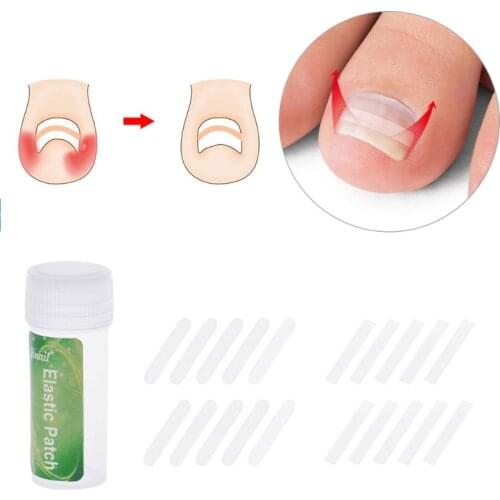 10Pcs Ingrown Toenails Treatment Straightening Tape Curved Clip Brace Patch Nail Wedge Paronychia Lifter Recover Foot Care Tool