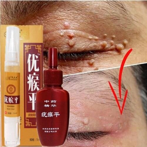 Skin Tag Remover Against Mole & Genital Wart fast RemovWithin al Anti Foot Corn Removal Warts Papillomas Rapidly removes moles