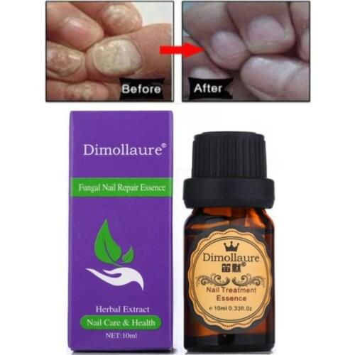 2pcs Dimollaure Herbal Fungal Nail Treatment Essence Hand Foot Toe Nail Fungus Removal Infection Feet Care Nail Gel Paronychia