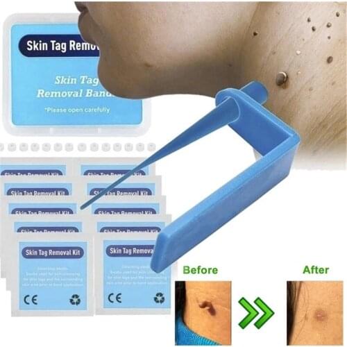 Medical micro skin tag remover Skin Mole Wart Remover Micro Band Skin Tag Removal Kit With Cleansing Swabs Adult Mole Face Care