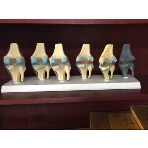 Knee joint pathology model articular osteopathy morbidity display human knee joint disease model teaching model