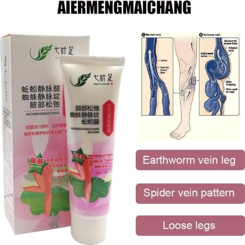 Varicose Veins Cream Treatment Phlebitis Vasculitis Spider Leg Swelling Pain Relief Medical Ointment Body Care
