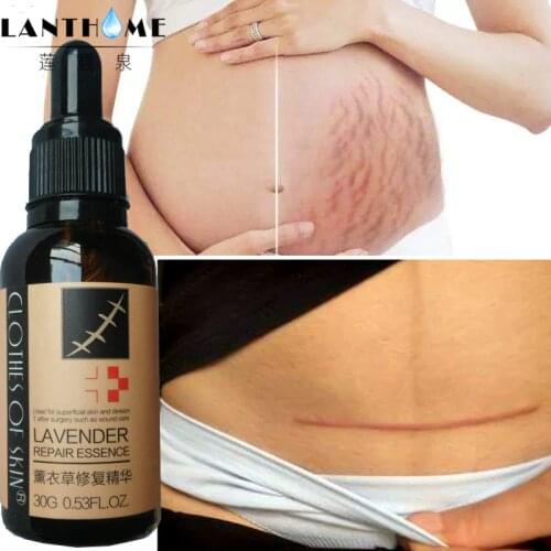 Lanthome Stretch Mark Oils China