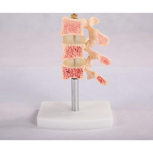 BIX-A1015 Human Osteoporosis Anatomical Model (3 Vertebrae) WBW344