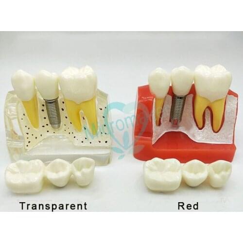 Dental Removable Model Teach Implant Crown Bridge Dental Demonstration Teeth Model