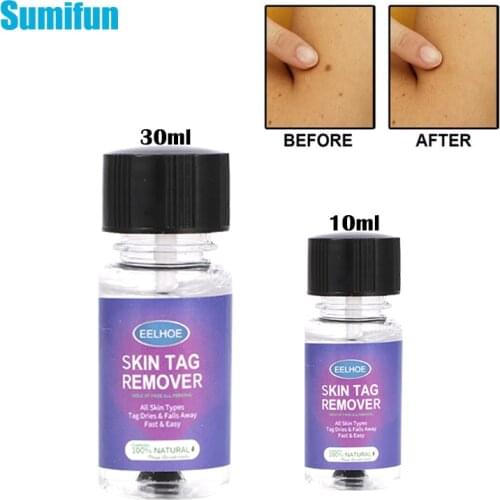 10/30ml Remover Warts Removal Relief Medical Treatment Meat Corn Flat Wart Antibacterial Liquid Foot Calluses Skin Care Cream