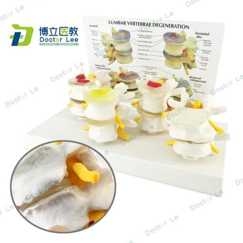 Human 1:1 Life Sized Lumbar Spine Normal Lesion Combination Anatomy Model Intervertebral Disc Pain Model Teaching Bone Model