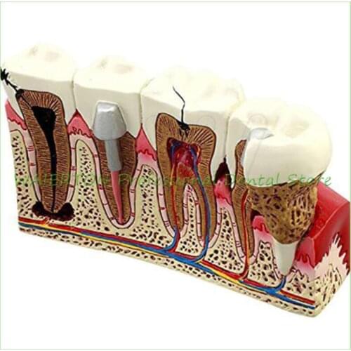 Dental Caries anatomy tooth Model Caries anatomy model Teaching&study